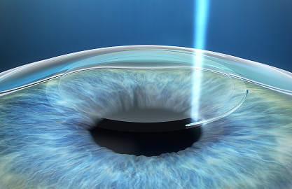Femtosecond Laser