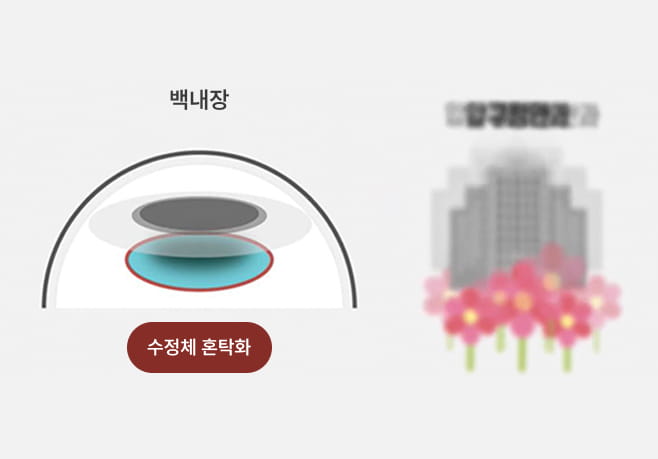 백내장