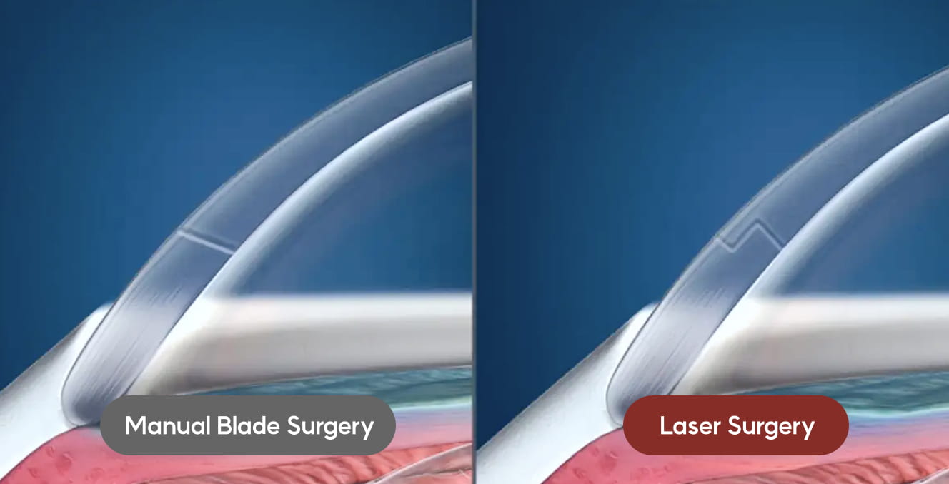 난시 교정 동시 고려 가능