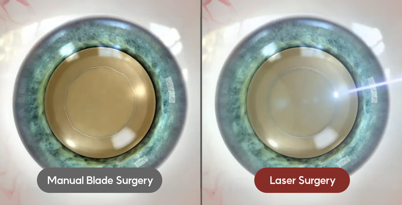인공수정체 위치 정확도 향상