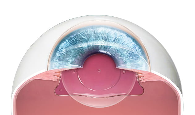 각막 비절삭 방식