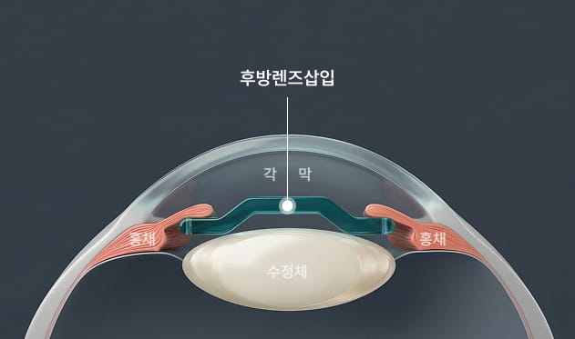 가역적 시력교정